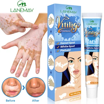 Vitiligo Krém Potu Mieste Vitiligo Mieste Pokožky Aktuálne Krém Mieste Starostlivosti Repair Cream