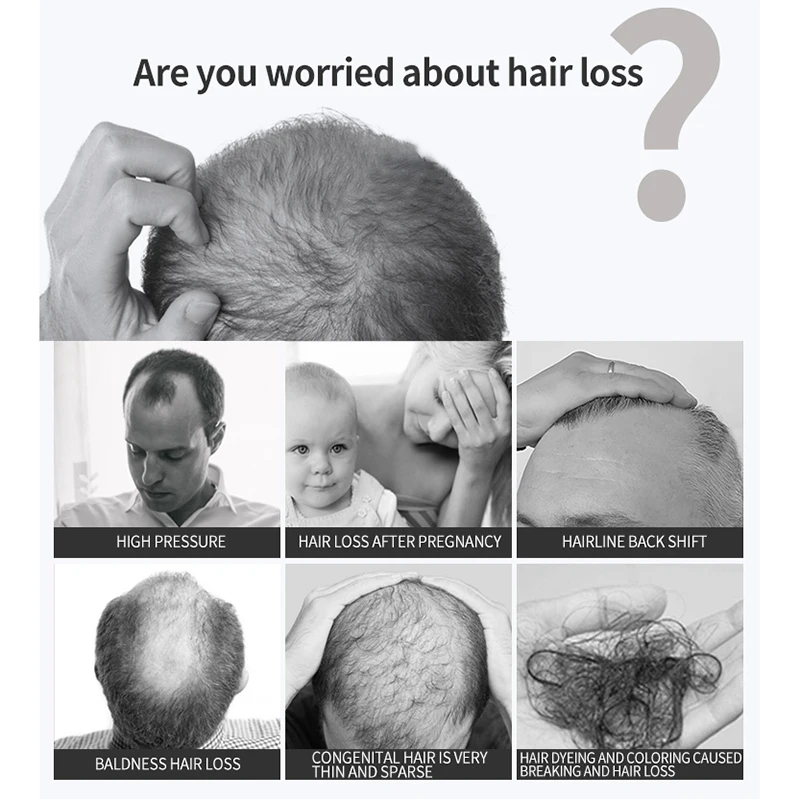 Rast vlasov Olej Anti-Hair Loss Care Sprej Mužov a Žien vlasovej Pokožky Starostlivosť o Silné Vlasy, vlasovú Pokožku, Olej Ovládanie Obrázok 1